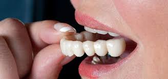 Dental crowns and bridges